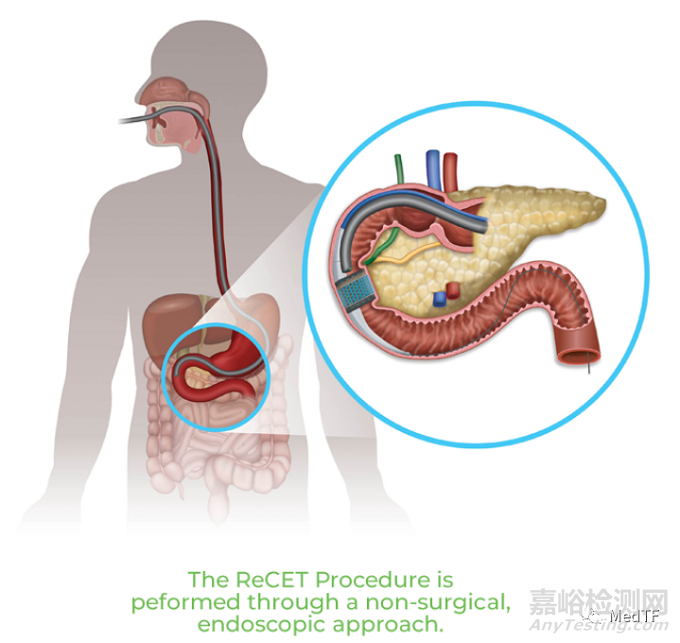 ReCET：电脉冲消融治疗糖尿病