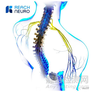 Avantis：脊髓刺激器恢复中风患者上肢运动