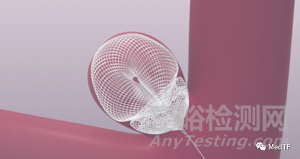 水母型的瘤内扰流装置完成IDE临床研究主要队列入组