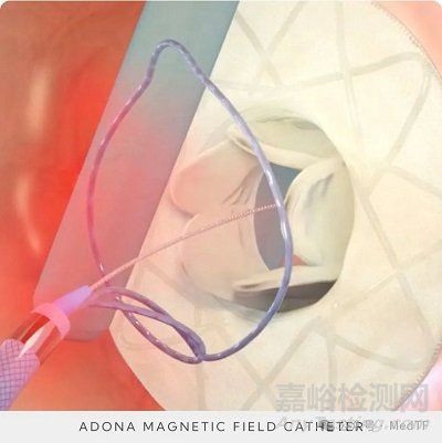 【创新医械】Adona：流道大小可调节的心房分流器完成临床入组，100%植入成功率
