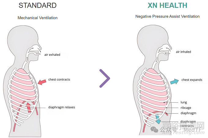 【创新医械】Phlex：经气管膈神经刺激器械，减少呼吸机引起的肺损伤
