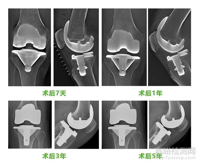 嘉思特创新医械生物型膝关节假体系统技术解析