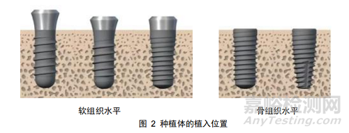 《牙科种植体系统生产环节风险清单和检查指南》