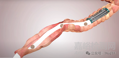 Colovac：健适医疗支持的吻合口漏解决方案获批上市