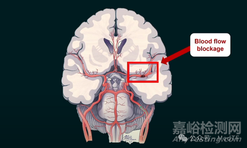 【创新医械】TRAP：带“牙齿”的抽吸导管，取栓成功率提高300%