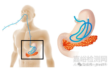 Arctx Cool Catheter：急性胰腺炎无创冷冻疗法