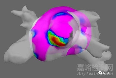 全球唯一集成高密度标测的PFA消融导管获批FDA