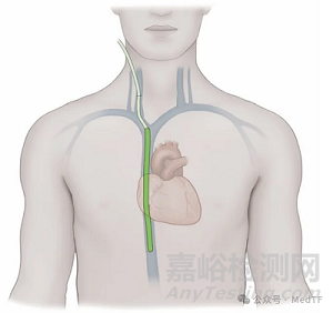 【创新医械】VQ Catheter：血管内氧合导管，血管内气体交换的ECMO