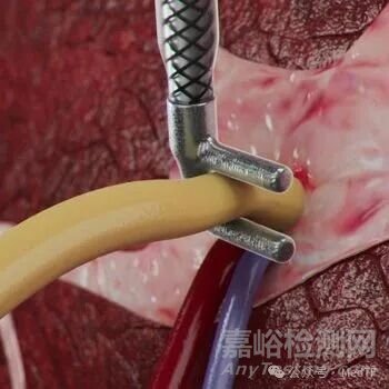 【创新医械】cryoXT：治疗疼痛的冷冻消融“夹”获批FDA，技术源于电生理
