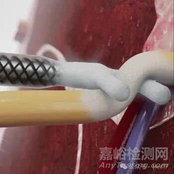 【创新医械】cryoXT：治疗疼痛的冷冻消融“夹”获批FDA，技术源于电生理