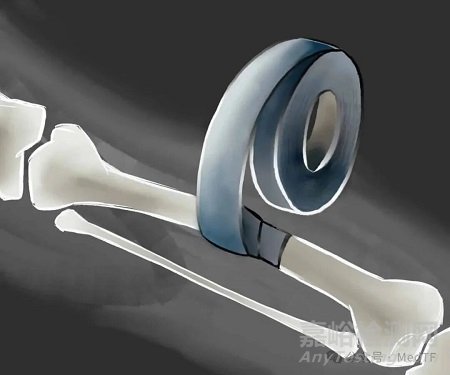 【创新医械】BoneTape：治疗骨折“创可贴” ，取代骨钉骨板