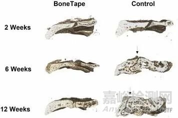 【创新医械】BoneTape：治疗骨折“创可贴” ，取代骨钉骨板