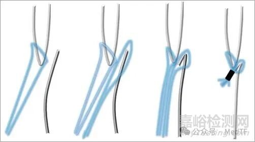 【创新医械】NobleStitch卵圆孔缝合器，相比封堵器更安全