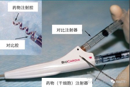 CardiAMP：自体细胞使心绞痛发作频率降低82% | 明显优于药物